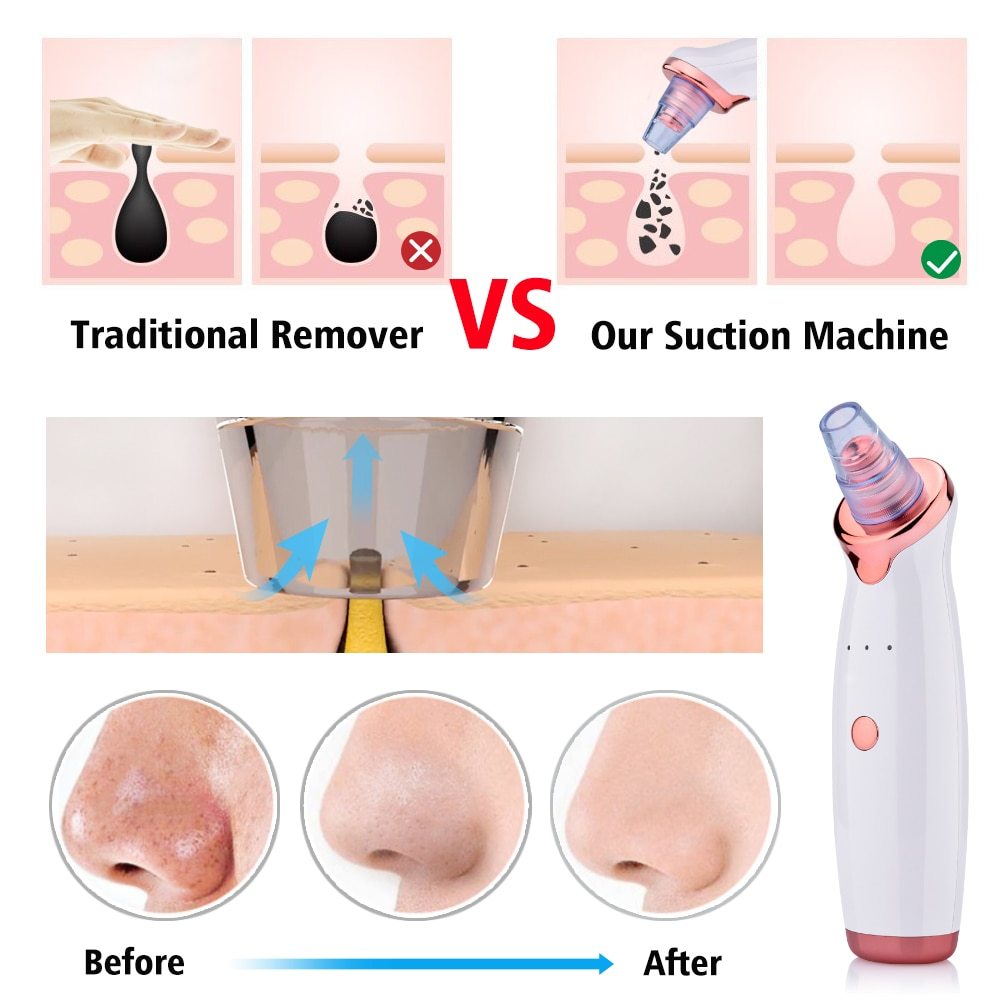 JMT-057866 Electric Blackhead Remover with 5 Suction Heads, Acne Treatment & Skin Rejuvenation Device