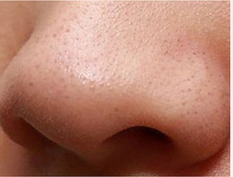 JMT-707466 Intelligent Blackhead Removal Device with Hot and Cold Cupping Feature