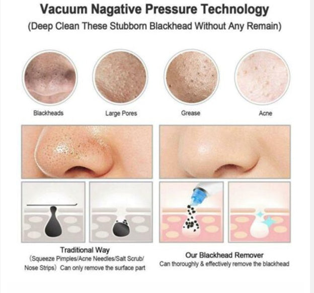 JMT-716938 Facial Pore Cleaner with Vacuum Suction for Acne and Skin Rejuvenation