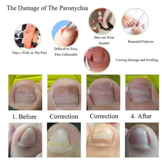 JMT-721290 Ingrown Toenail Correction Patch for Healthy Nail Growth and Pain Relief