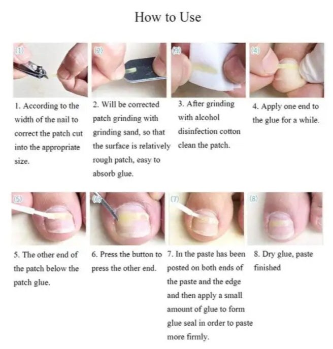 JMT-721290 Ingrown Toenail Correction Patch for Healthy Nail Growth and Pain Relief