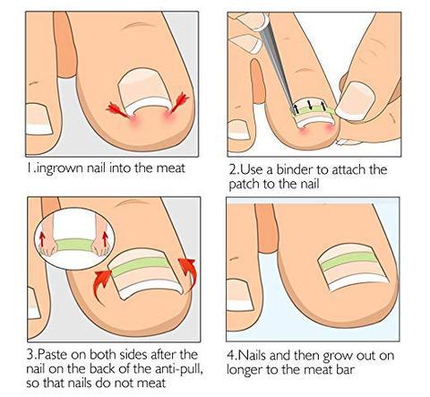JMT-721290 Ingrown Toenail Correction Patch for Healthy Nail Growth and Pain Relief